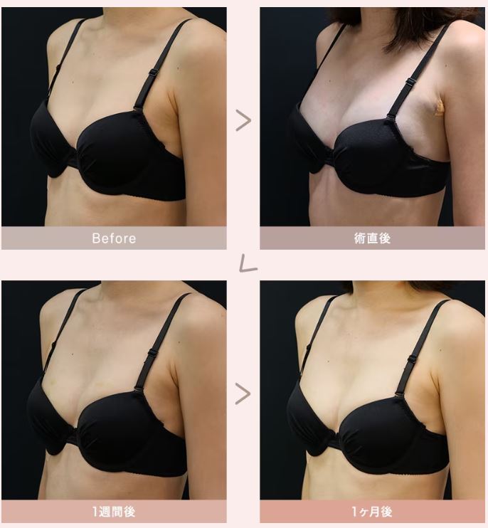 湘南 脂肪注入 プチ豊胸